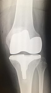 Student's knee replacement
