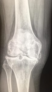 Student's second arthritic knee
